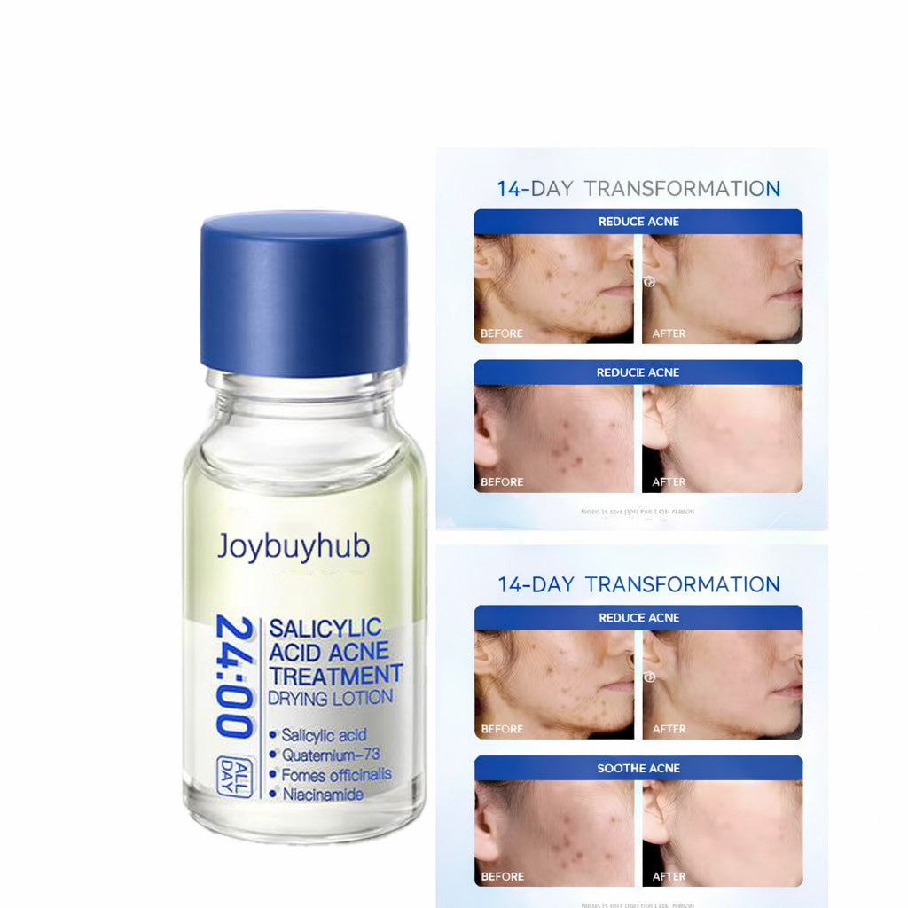 🔥[6𝟎% 𝐎𝐅𝐅 𝐋𝐀𝐒𝐓 𝐓𝐇𝐑𝐄𝐄 𝐃𝐀𝐘𝐒] 24H Acne & Pimple Treatment Drying Lotion | Salicylic Acid + Sulfur + Niacinamide | Viral Product | Inflammation Relief, Post-Blemish Care & High Pressure Pimple Relief-AAA1