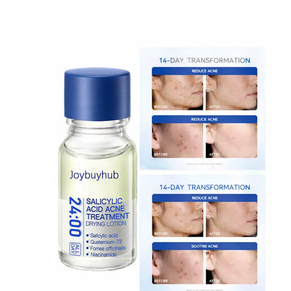 🔥[6𝟎% 𝐎𝐅𝐅 𝐋𝐀𝐒𝐓 𝐓𝐇𝐑𝐄𝐄 𝐃𝐀𝐘𝐒] 24H Acne & Pimple Treatment Drying Lotion | Salicylic Acid + Sulfur + Niacinamide | Viral Product | Inflammation Relief, Post-Blemish Care & High Pressure Pimple Relief-AAA1