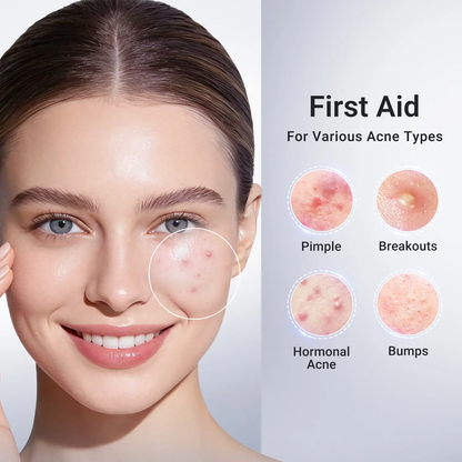 🔥[5𝟎% 𝐎𝐅𝐅 𝐋𝐀𝐒𝐓 𝐓𝐇𝐑𝐄𝐄 𝐃𝐀𝐘𝐒]Dr.Leo Drying Lotion Plus | Acne & PimpleTreatment I Visibly Shrinks Pimples in 24 Hours& Helps Fade Acne Marks in 7 Days I With 1.8%Encapsulated Salicylic Acid, 4% Niacinamide &10% Sulfur (20ml)-JKL