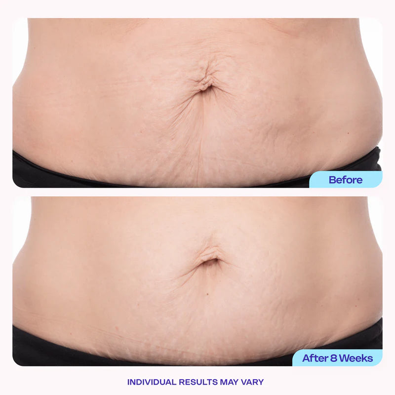 🔥[65% 𝐎𝐅𝐅 𝐋𝐀𝐒𝐓 𝐓𝐇𝐑𝐄𝐄 𝐃𝐀𝐘𝐒]Tighten & Smooth Belly Firming Cream-LU