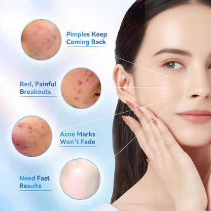 🔥[6𝟎% 𝐎𝐅𝐅 𝐋𝐀𝐒𝐓 𝐓𝐇𝐑𝐄𝐄 𝐃𝐀𝐘𝐒] 24H Acne & Pimple Treatment Drying Lotion | Salicylic Acid + Sulfur + Niacinamide | Viral Product | Inflammation Relief, Post-Blemish Care & High Pressure Pimple Relief-AAA1