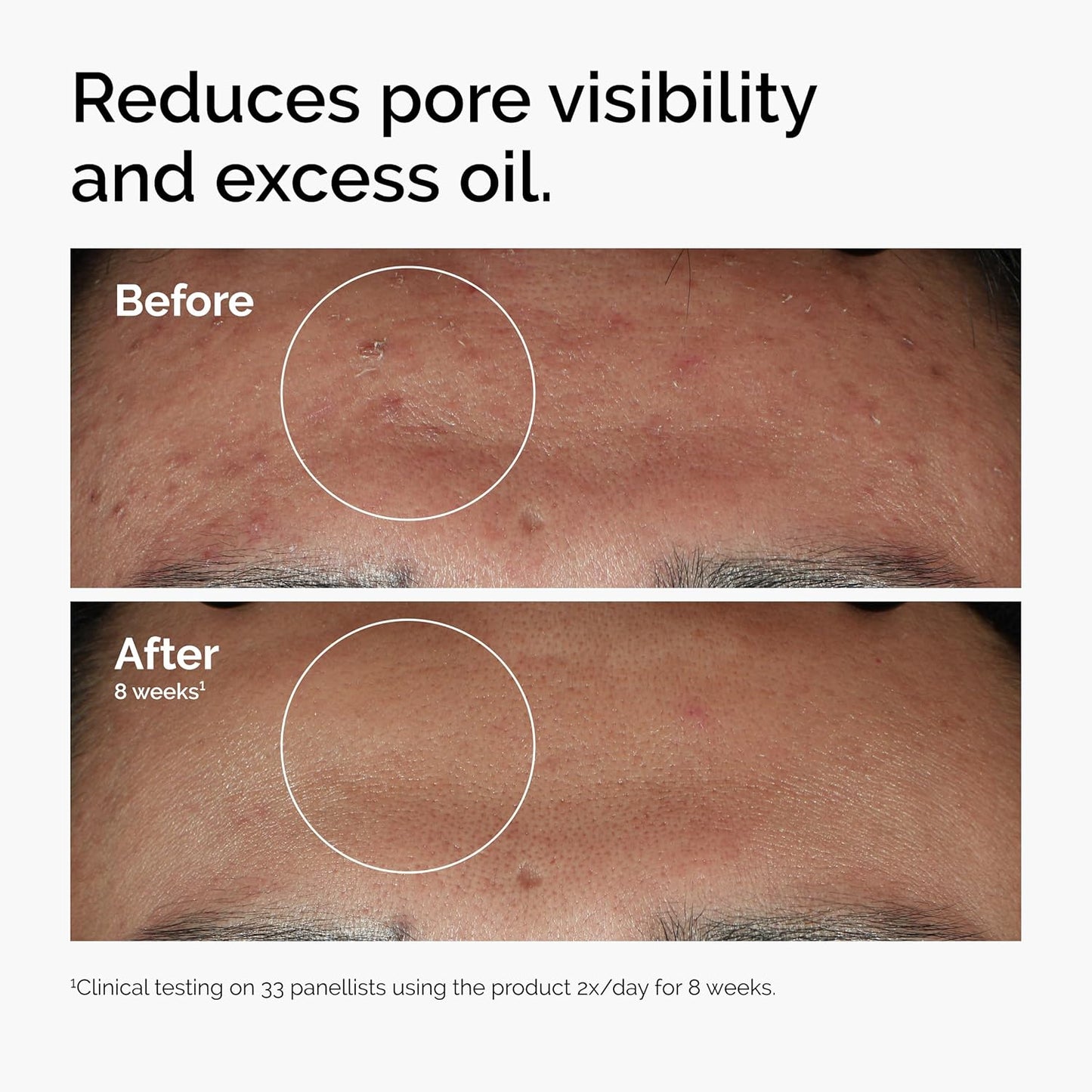 🔥[5𝟎% 𝐎𝐅𝐅 𝐋𝐀𝐒𝐓 𝐓𝐇𝐑𝐄𝐄 𝐃𝐀𝐘𝐒]The Ordinary Niacinamide 10% + Zinc 1%, Smoothing Serum for Blemish-Prone Skin-JKL