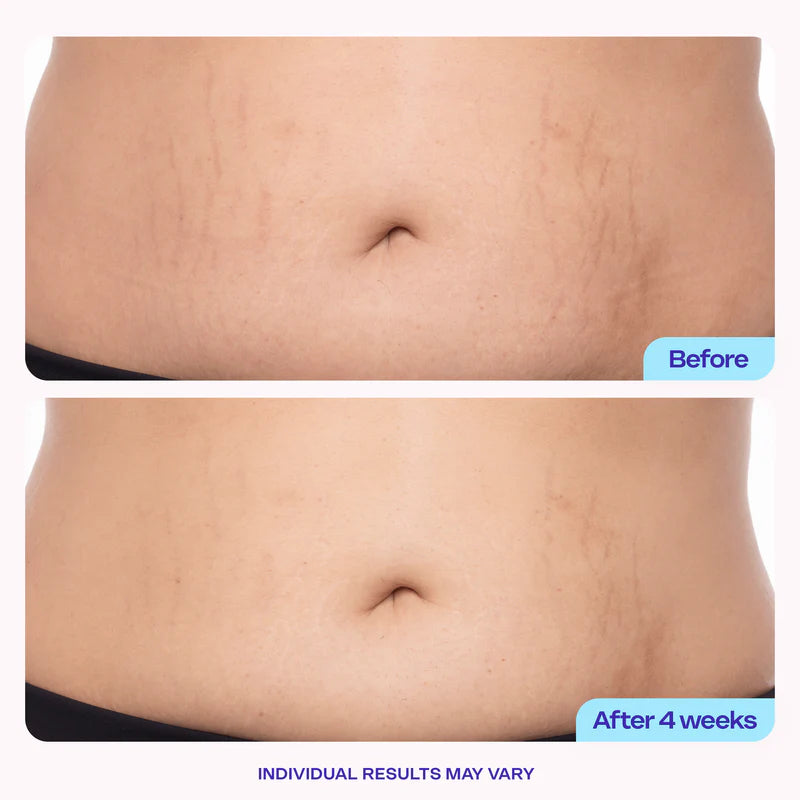🔥[65% 𝐎𝐅𝐅 𝐋𝐀𝐒𝐓 𝐓𝐇𝐑𝐄𝐄 𝐃𝐀𝐘𝐒]Tighten & Smooth Belly Firming Cream-LU