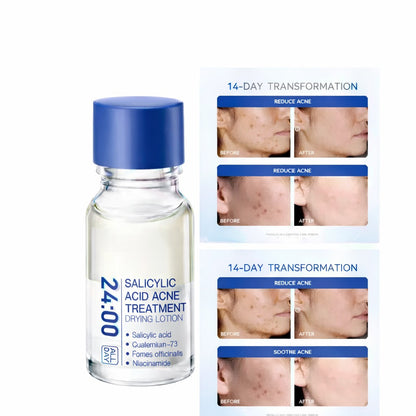 🔥[75% 𝐎𝐅𝐅 𝐋𝐀𝐒𝐓 𝐓𝐇𝐑𝐄𝐄 𝐃𝐀𝐘𝐒]24H Acne & Pimple Treatment Drying Lotion | Salicylic Acid + Sulfur + Niacinamide | Viral Product | Inflammation Relief, Post-Blemish Care & High Pressure Pimple Relief-3@OK