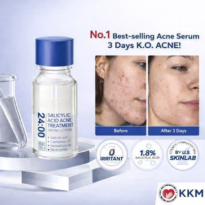 🔥[75% 𝐎𝐅𝐅 𝐋𝐀𝐒𝐓 𝐓𝐇𝐑𝐄𝐄 𝐃𝐀𝐘𝐒]24H Acne & Pimple Treatment Drying Lotion | Salicylic Acid + Sulfur + Niacinamide | Viral Product | Inflammation Relief, Post-Blemish Care & High Pressure Pimple Relief-3@OK