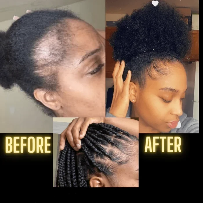 [🔥Fresh Deals Are Here🔥] Scalp Stimulator Hair Growth Oil - Lightweight Rosemary & Mint Blend for Thicker, Fuller Hair, Alopecia Support & Hair Regrowth-LU