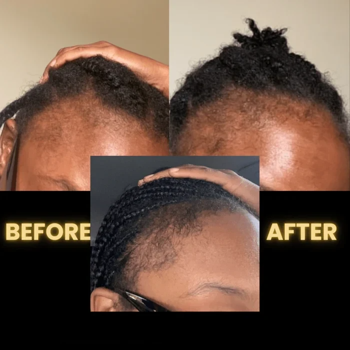 [🔥Fresh Deals Are Here🔥] Scalp Stimulator Hair Growth Oil - Lightweight Rosemary & Mint Blend for Thicker, Fuller Hair, Alopecia Support & Hair Regrowth-LU